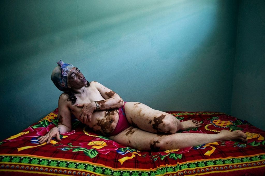 vitiligo imp festival fotogiornalismo padova 2021